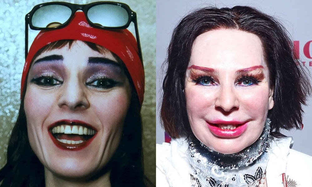 Жанна агузарова до и после пластики фото